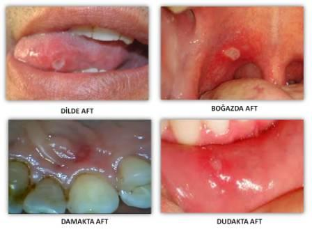 Ağız içerisindeki yaralar: Nedenleri ve Tedavi Yöntemleri