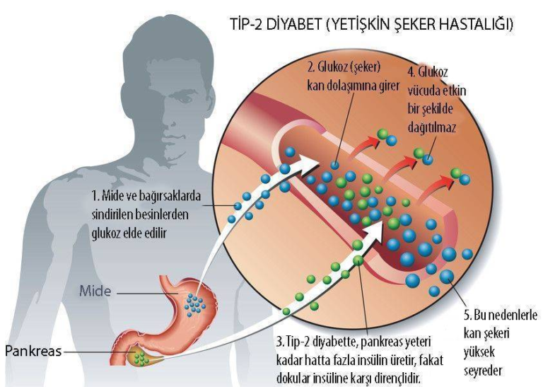 Diyabet: Belirtileri, Nedenleri ve Tedavisi Hakkında